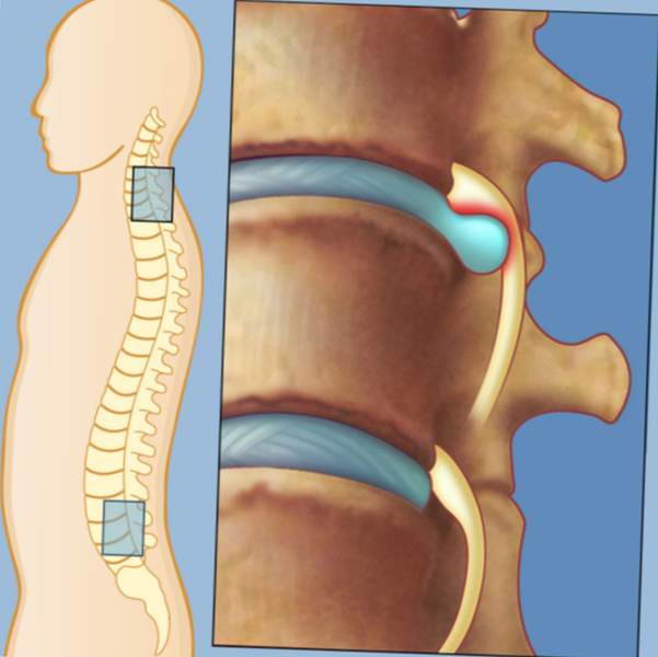 hernia en la columna vertebral
